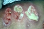 Vergonha: Vídeo mostra paciente com bichos nas feridas – Jovem denuncia descaso no hospital Regional de Ariquemes 