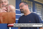 Secretaria de Sa&uacute;de alerta popula&ccedil;&atilde;o de Ariquemes sobre cuidados contra Hansen&iacute;ase &ndash; V&iacute;deo