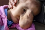 Após remoção de hérnia facial, garota de 4 anos tem vida nova
